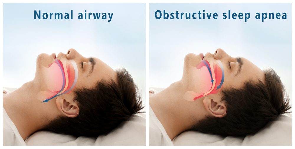 cushing-s-syndrome-patients-at-higher-risk-for-sleep-apnea-taiwan