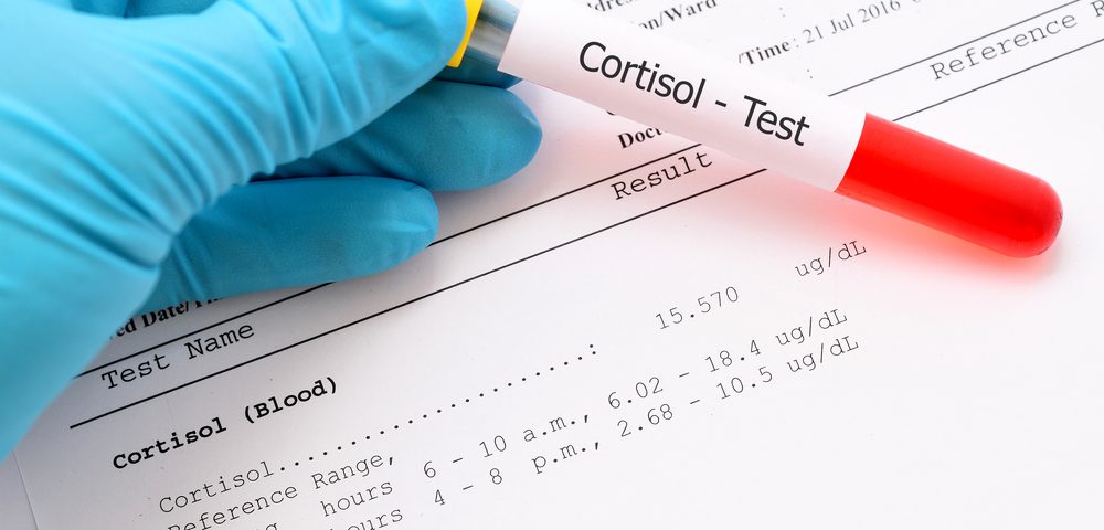 ACTH/Cortisol Ratio May Be Reliable Test to Diagnose Cushing's Disease
