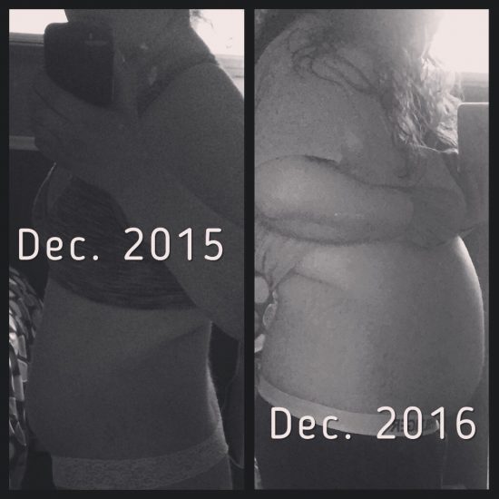 How I Dealt with Cushing's Disease Before, During and After Diagnosis