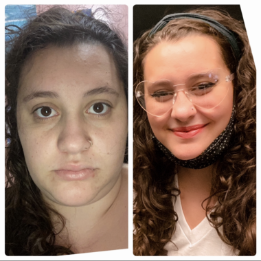 Two side-by-side photos show a close-up of a person's face six months apart. In the pre-Cushing's photo, they're smiling, wearing clear heart-shaped glasses, and their long brown hair is curly and styled. In the photo of them with active Cushing's, their hair is tied back in a messy ponytail and they're not wearing makeup. They have a neutral expression and appear to have gained weight.