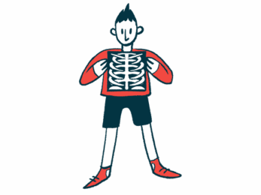 A person holds an X-ray image of the rib cage with two hands at chest level.