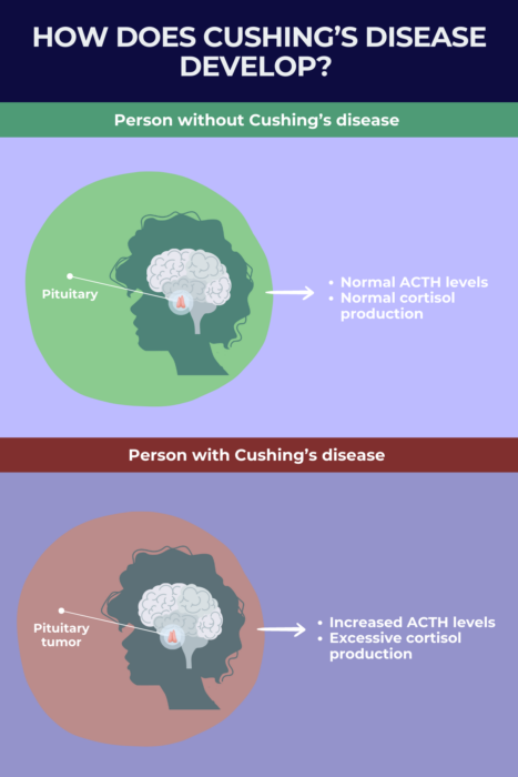 Infographic showing how Cushing's disease develops.
