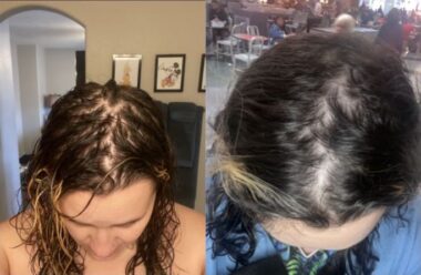 Two side-by-side photos taken from a high angle show a person's scalp, one month apart. The earlier image reveals more hair loss and bald patches, which have filled in somewhat in the more recent image.