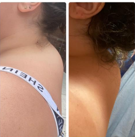 Two side-by-side photos give a close-up of a person's "buffalo hump," which developed just below the back of their neck.