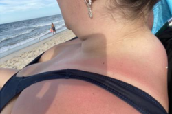 A close-up photo of a person wearing a swimsuit and sitting on the beach shows their buffalo hump protruding just below the back of their neck.